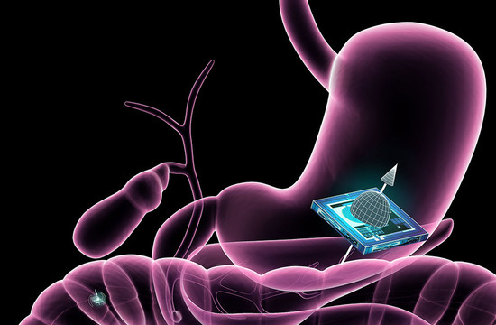illustration of an ATOMS microchip localized within the gastrointestinal tract
