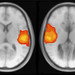 Left: Activity in a healthy brain. Right: Activity in a brain with agenesis of the corpus callosum