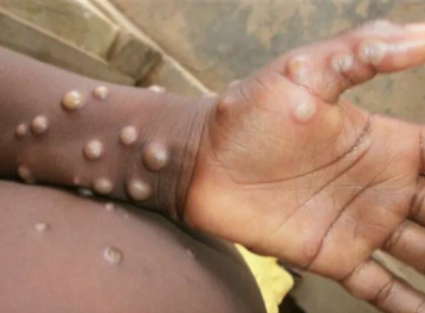 10 datos que debes conocer sobre la viruela del mono.