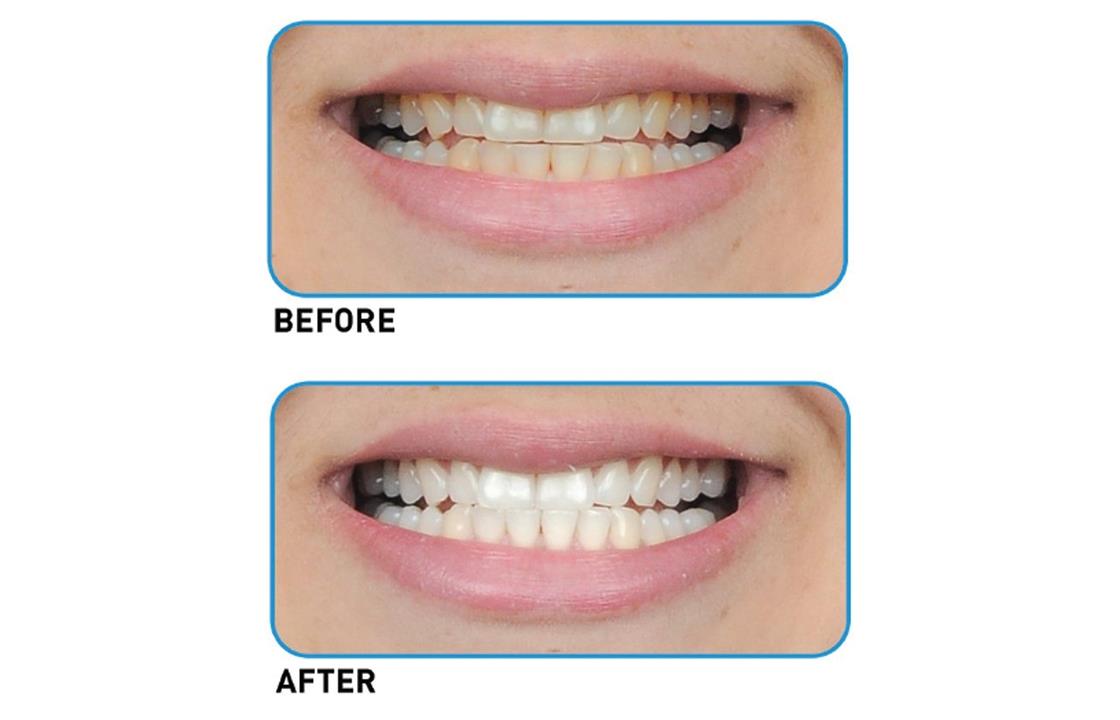 Go Smile on the Go Teeth Whitening Pen