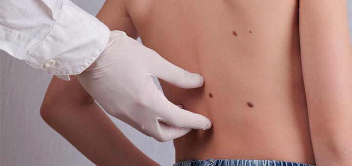 hand-on-skin-tag