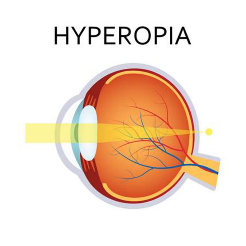 Hyperopia