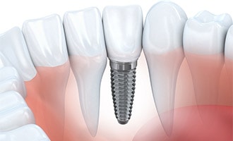 Illustration of a dental implant