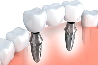 Diagram of implant-supported bridge