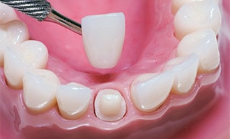 A dental crown being placed