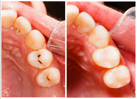 Composite fillings San Jose