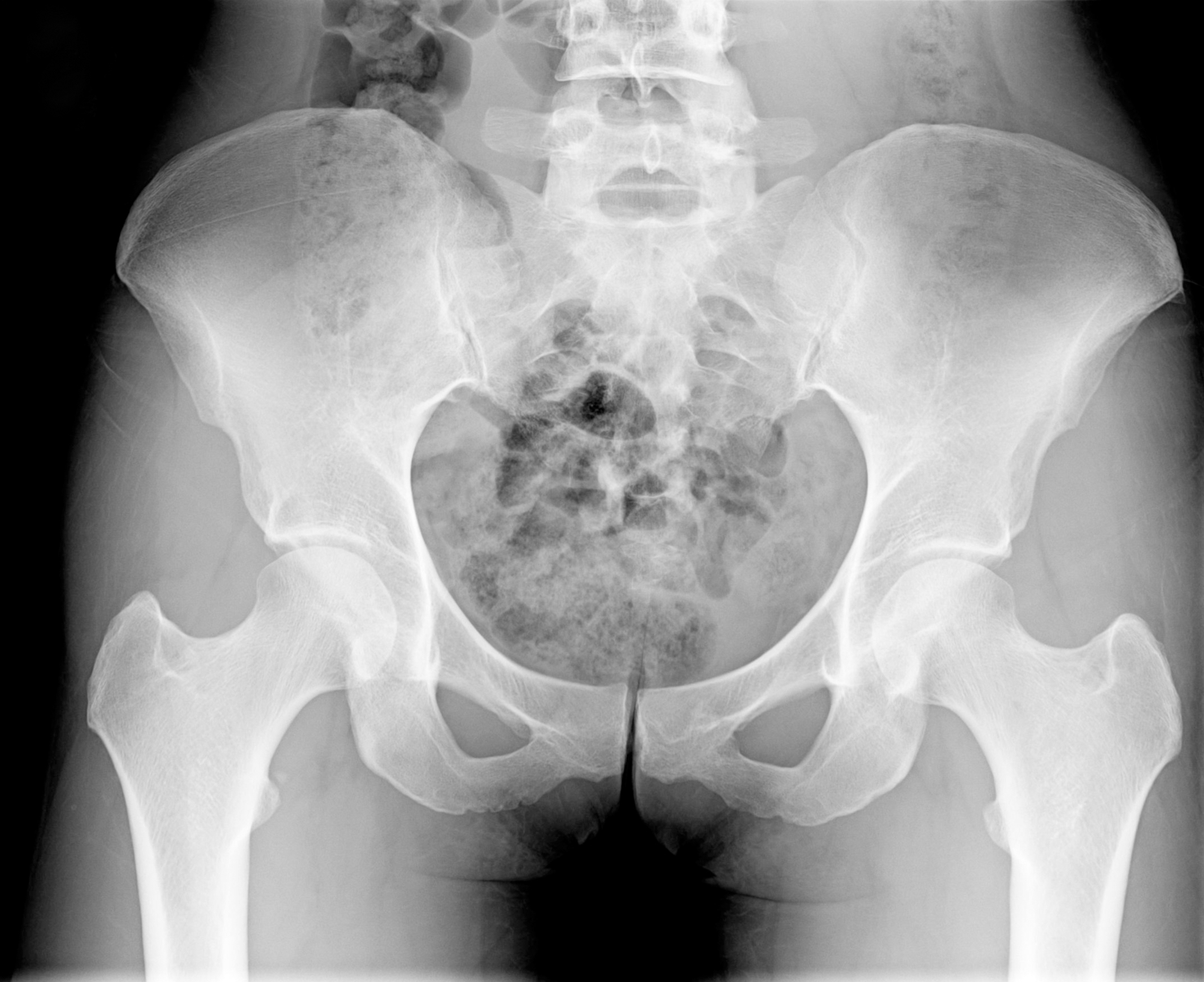 saddle joint xray