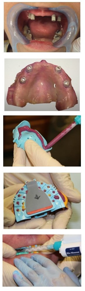 Dentca