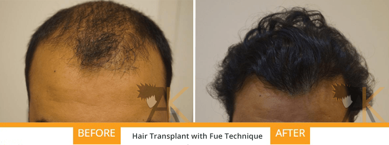 FUE hair transplant AK Clinics India