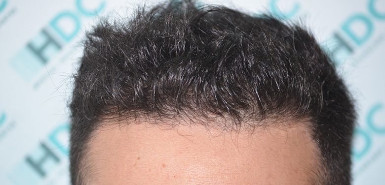 hdc hair transplant 