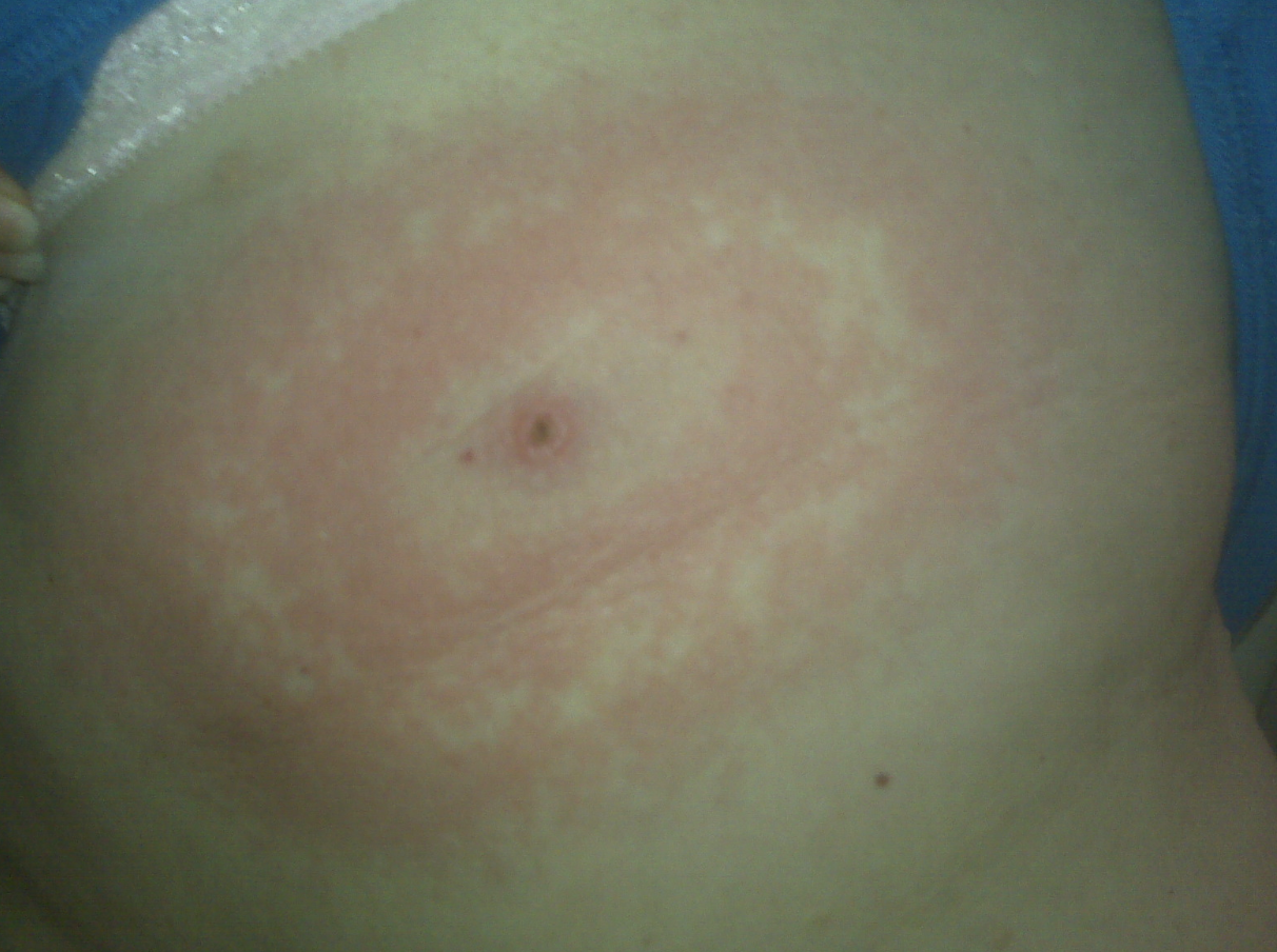 What S My Rash Pictures And Descriptions Of 21 Rash Types Plushcare